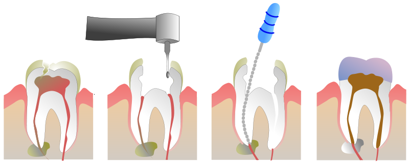 درمان ریشه دندان یا عصب کشی دندان 