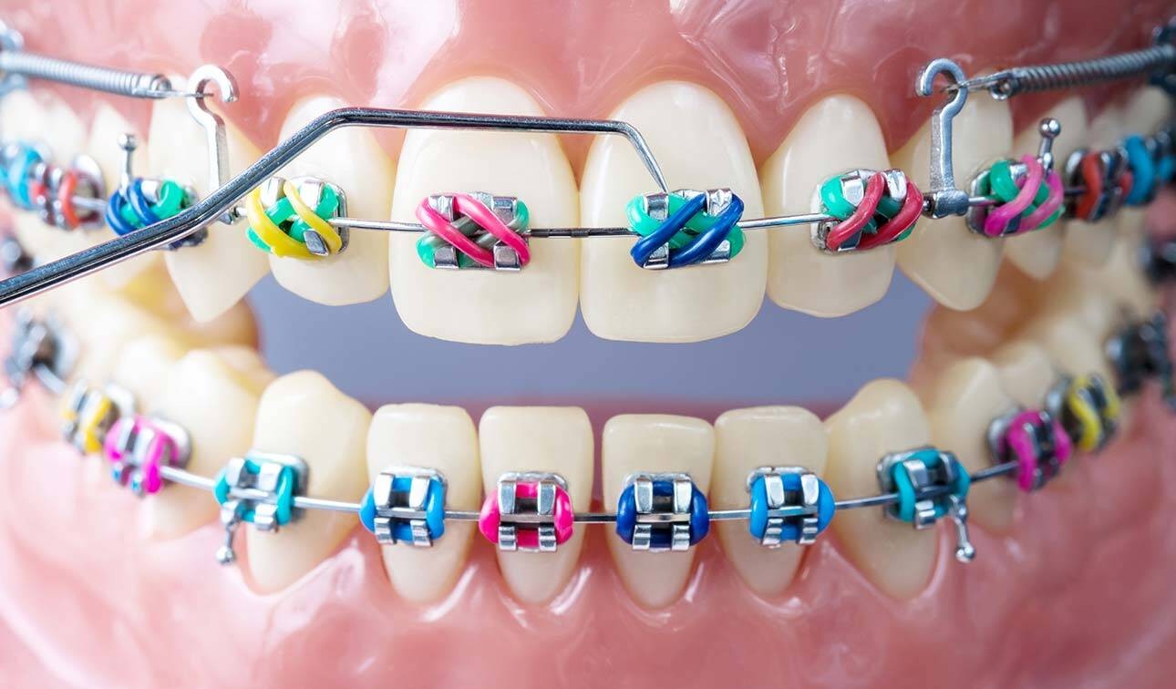 ارتودنسی دندان در بزرگسالی