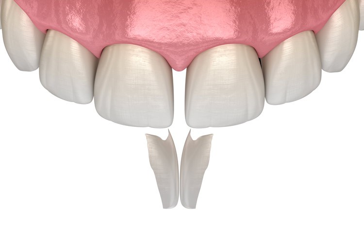 لایه کامپوزیت مستقیما روی دندان ها قرار داده می شود
