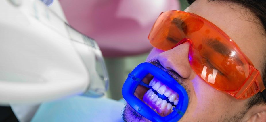 نحوه انجام بلیچینگ دندان در کلینیک دندانپزشکی
