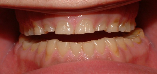 دندان درد و دندان قروچه