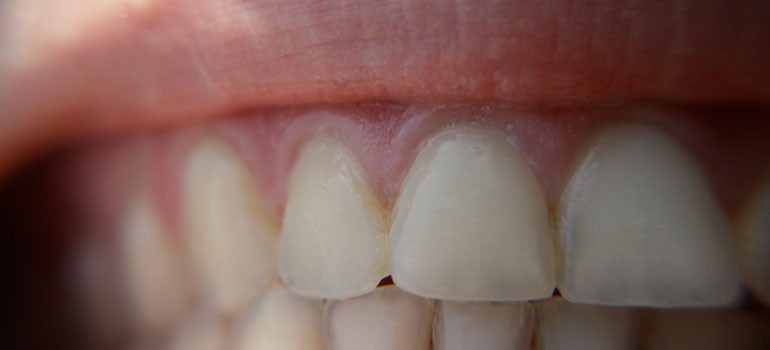 سفید کردن دندان ها و بلیچینگ