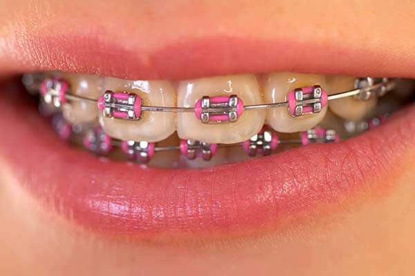 بریس های ارتودنسی دندان و ریتینر ها ( نگهدارنده های دندان )