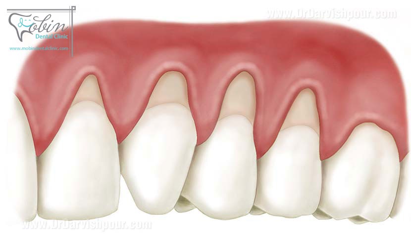 تحلیل لثه ها به علت مشکلات دهان و دندان