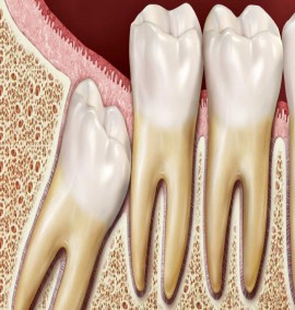 دندان عقل چیست؟ انواع دندان عقل و مراقبت های بعد از کشیدن دندان عقل