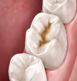 پوسیدگی دندان و نشانه های آن