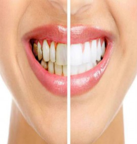 علت سیاه شدن دندان ها چیست؟