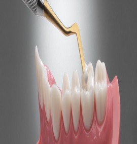 7 مزیت پر کردن دندان با کامپوزیت رزین