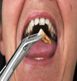 کشیدن و یا ترمیم دندان های آسیب دیده