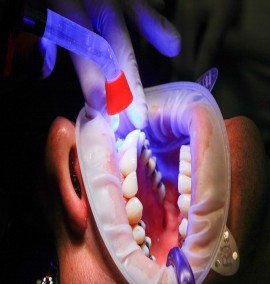 انواع ترمیم دندان و کامپوزیت رزین