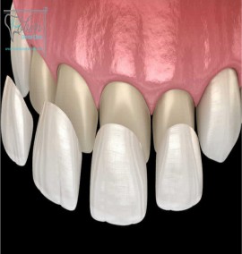مشکلات و عوارض لمینت دندان