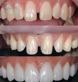 بررسی تفاوت های ایمپلنت و لمینت دندان