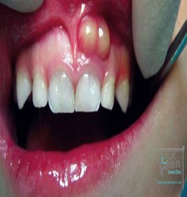 عفونت دندان و آبسه دندان