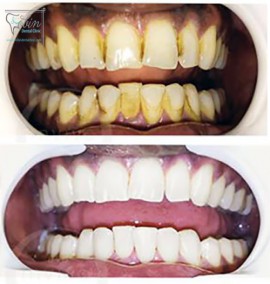 کامپوزیت دندان و بلیچینگ چه تفاوتی دارند؟