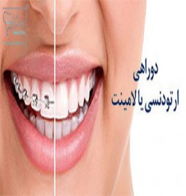 بررسی تفاوت لمینت دندان و ارتودنسی دندان