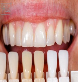 بررسی سوالات متداول کامپوزیت دندان