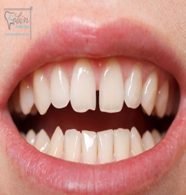 معرفی روش های از بین بردن فاصله دندان ها