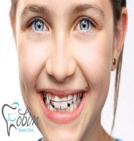 ارتودنسی دندان کودکان چگونه انجام می شود؟