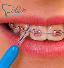 آشنایی با مراقبت های لازم دوران ارتودنسی دندان