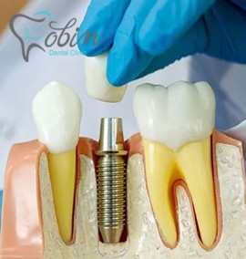 همه چیز درباره ی روش های ایمپلنت دندان