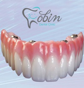 ایمپلنت دندان یک روزه: جایگزین دندان های از دست رفته