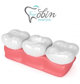 بهترین نوع کامپوزیت دندان کدام است؟