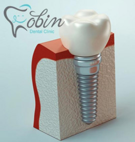 روش های رایج ایمپلنت دندان
