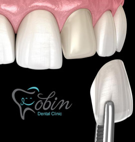 چه عواملی روی کیفیت و دوام کامپوزیت دندان تاثیر می گذارند؟