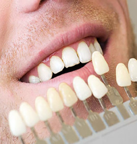 اصلاح طرح لبخند با انجام کامپوزیت دندان