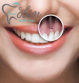 پاسخ به مهمترین سوالات در مورد ایمپلنت دندان!