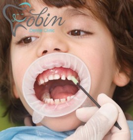 فلوراید تراپی در کودکان: فلوراید تراپی صحیح برای جلوگیری از پوسیدگی دندان