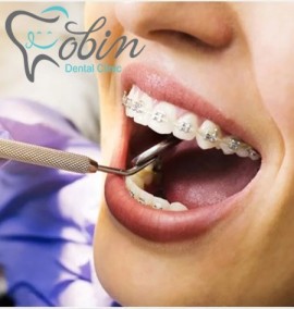 نکات مهم انجام ارتودنسی دندان در زنان باردار