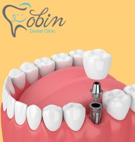 عوامل کاهش و افزایش قیمت ایمپلنت دندان