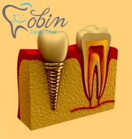 بررسی تعداد و انواع برندهای ایمپلنت دندان و تقویت استخوان فک
