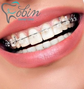 درمان مشکلات گفتاری و دندانی با ارتودنسی دندان
