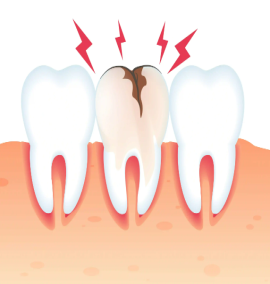 پوسیدگی دندان چیست و چه چیزی باعث پیدایش آن می‌شود؟