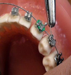 مراقبت های قبل از ارتودنسی دندان