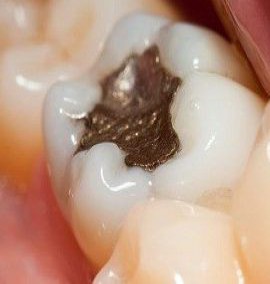 شما کدام روش را برای ترمیم دندان هایتان انتخاب می کنید؟