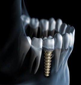 جراحی دندان، کشیدن دندان و مراقبت ها