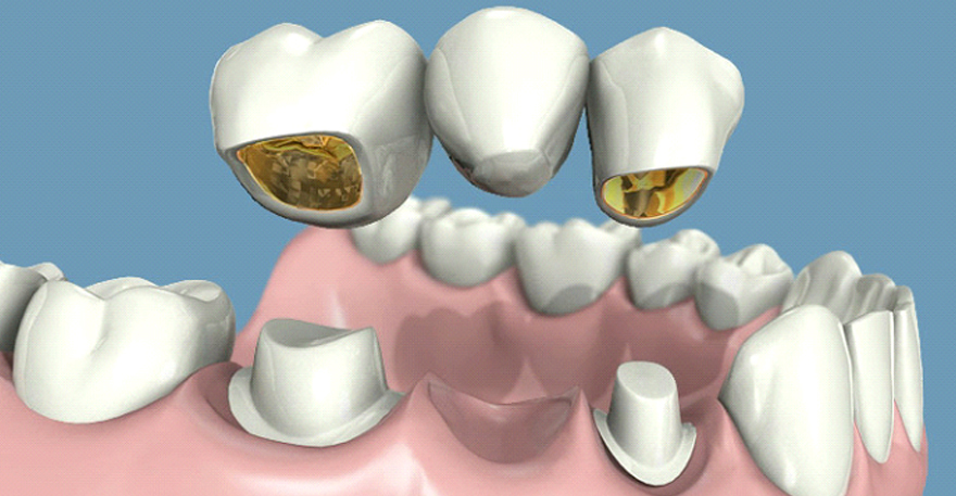 پروتز پل دندان