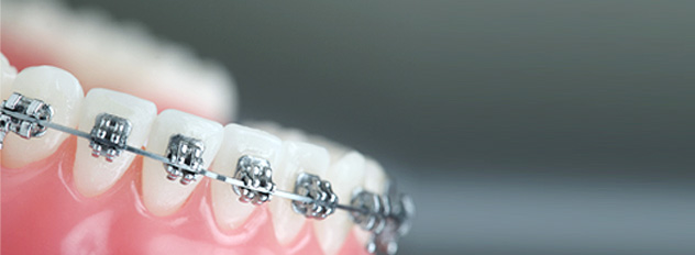 ارتودنسی دندان برای اصلاح طرح لبخند